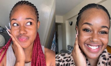 Inside Story Of Azziad Nasenya's 7-Year Battle With Acne