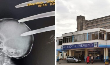 KNH: How Doctors Tried Saving Child With Fork Jembe Lodged In Head