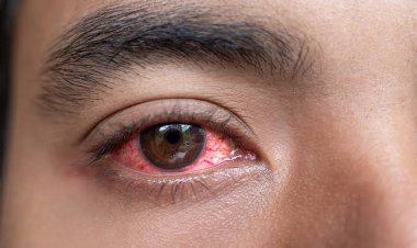 Govt Lists 5 Measures For Preventing Red Eye Disease Outbreak In Kenya