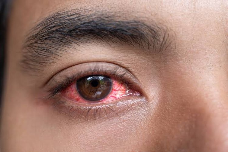 Govt Lists 5 Measures For Preventing Red Eye Disease Outbreak In Kenya