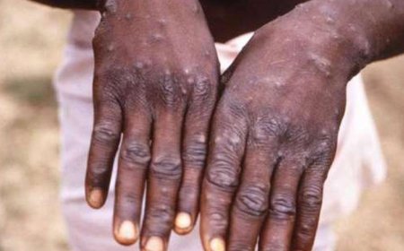 No New Mpox Cases Reported As Truck Driver Recovers- Kenya Declares