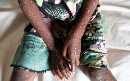 Kiambu County Reports Suspected Mpox Case