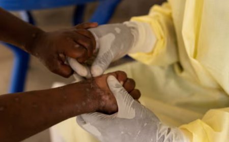 Kenya Confirms 5 New Suspected Mpox Cases