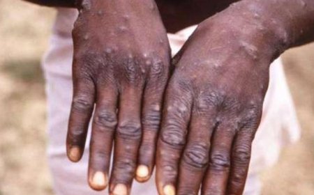Kenya Confirms Second Mpox Case