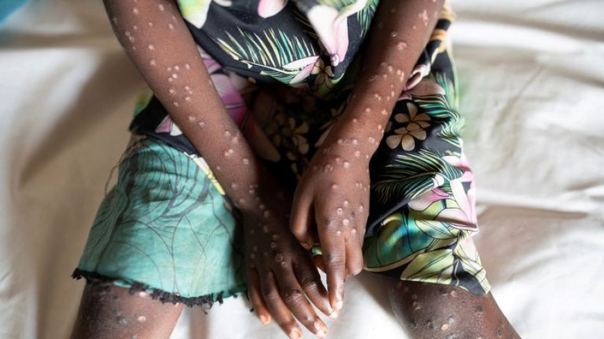 Kiambu County Reports Suspected Mpox Case