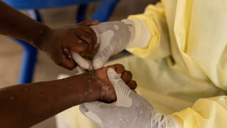 Kenya Confirms 5 New Suspected Mpox Cases