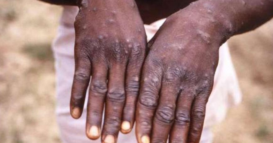 Kenya Confirms Second Mpox Case