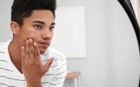 Why 1 in 3 Urban Kenyan Teens Are Dealing with Acne